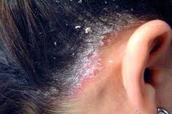 causas síntomas y tratamiento del eczema del cuero cabelludo